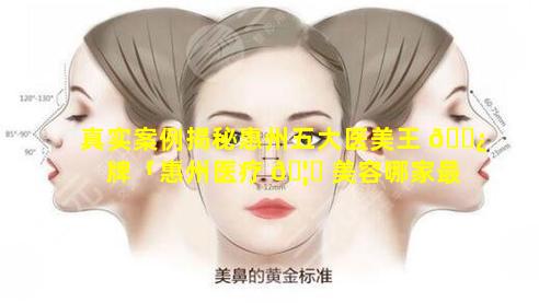 真实案例揭秘惠州五大医美王 🌿 牌「惠州医疗 🦆 美容哪家最好」